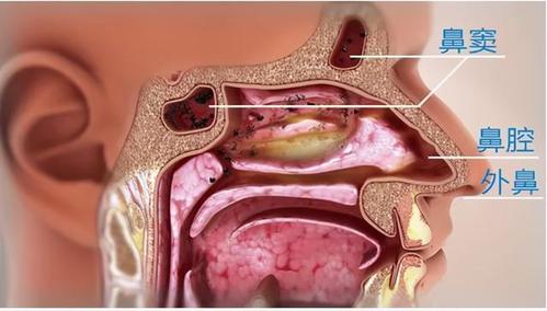 鼻炎or 鼻窦炎?一鼻之差,症状大不同