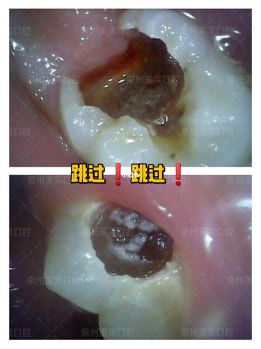 补牙要多久?先看看98蛀牙情况96辣眼睛_补牙_蛀牙