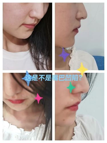 好想嘴凸,但这是不是嘴巴凹陷?姐妹们_嘴凸_美妆_医美