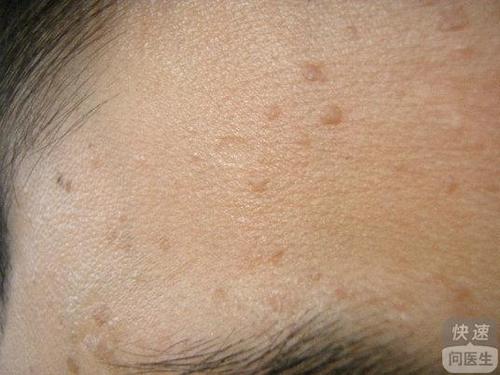 同时经医学研究发现hpv感染后有一部分会导致皮肤癌和宫颈癌等,同样