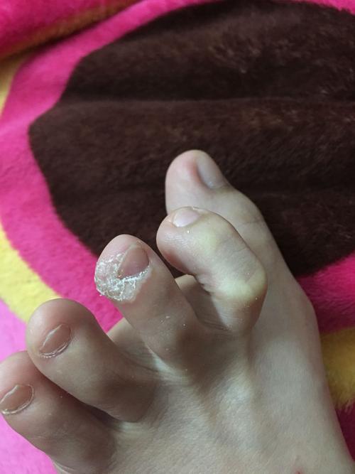 脚趾长白色半透明的硬皮,这是什么情况,严重吗?