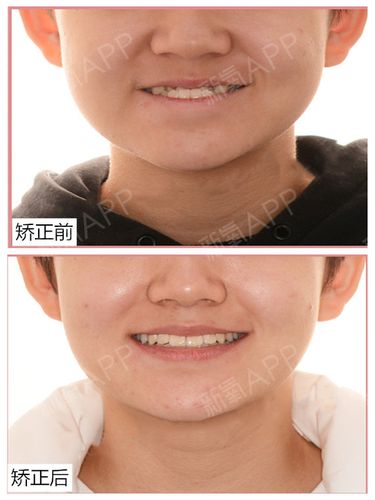 导致地包天的因素,你一定忘了这一个!