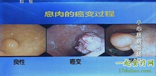 息肉的癌变过程