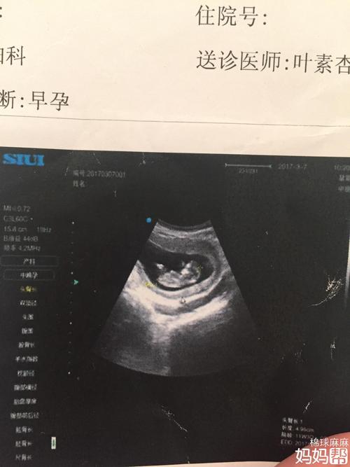 听说b超有显示亮点的就是男孩,是这样吗