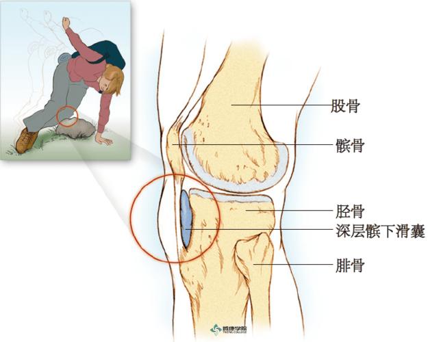 疼痛解剖学深层髌下滑囊炎