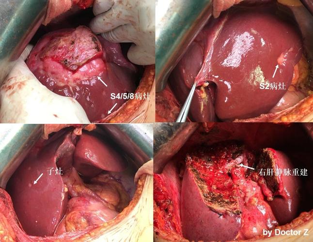 肝内胆管细胞癌转化治疗
