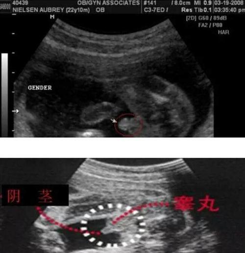 唐氏筛查,b超,四维彩超判定胎儿性别的方法