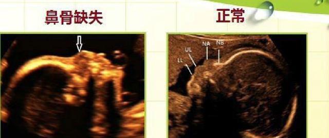 孕期四维大排畸,胎儿鼻骨缺如,还有希望别放弃,给胎儿一个机会