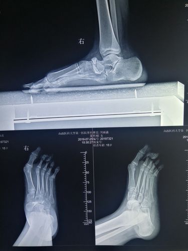 右足正侧斜位片