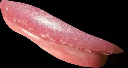 如图看一下是尖锐湿疣么?还是别的什么?严重吗?应该怎么办