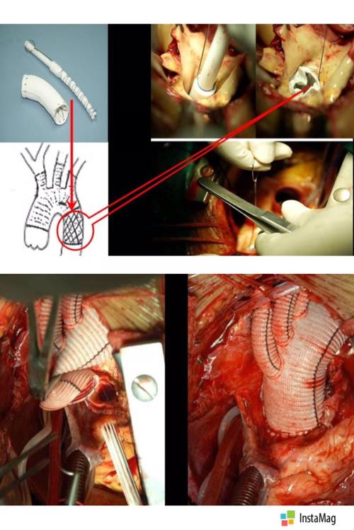 a型主动脉夹层全弓置换 "象鼻"支架置入手术
