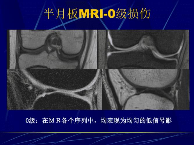 半月板损伤磁共振表现 ppt