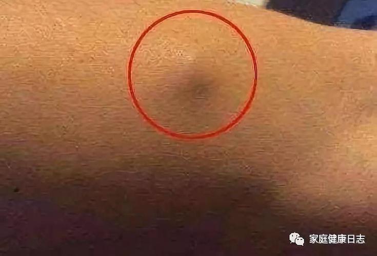 肿瘤医生: 身上这里有硬块, 可能是癌症的征兆, 大意不得