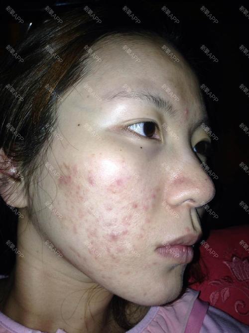 求助,皮肤很多痘坑痘疤,还有闭塞性粉刺及一点点痘痘.