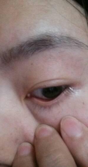 泪阜上,长个白色颗粒物,不痛也不痒的,还是无意间发现