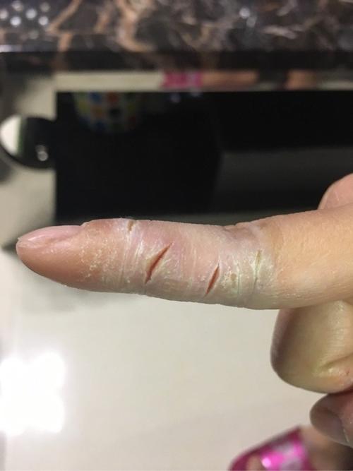 手指开裂?裂开口子,怎么办?