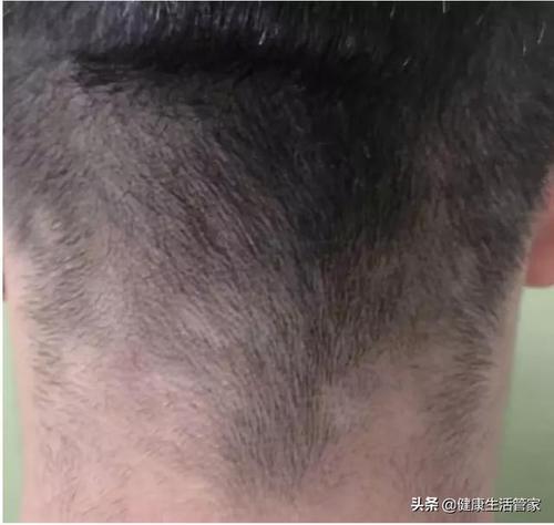 一开始以为是没睡好引起的,后来脱发逐渐加重,两侧和后方出现明显斑驳