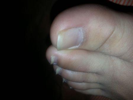 脚趾甲与肉分离上翘脚趾多肉如图