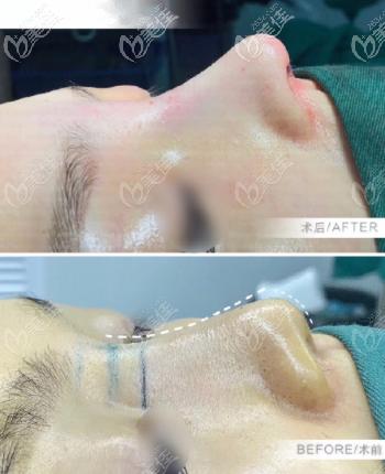 请问选国产立秀膨体垫鼻背是不是容易排异啊