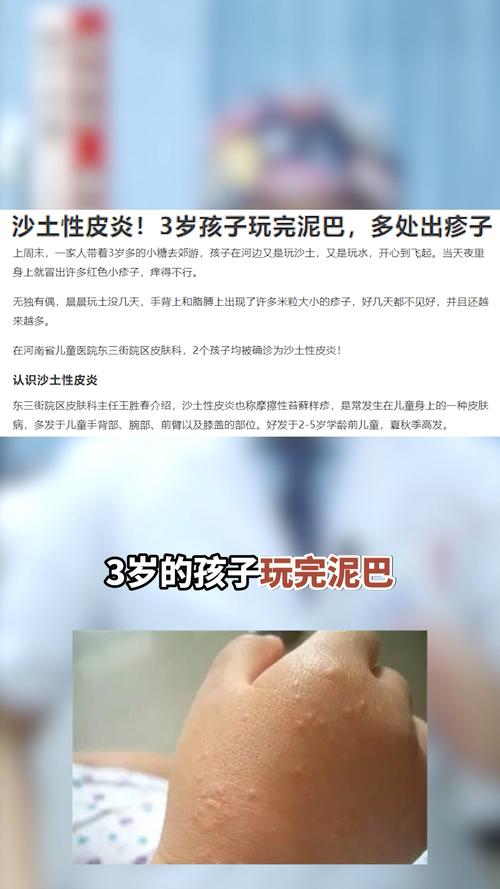七月确诊为沙土性的皮炎也叫摩擦性苔藓样,这是儿童的一种常见病