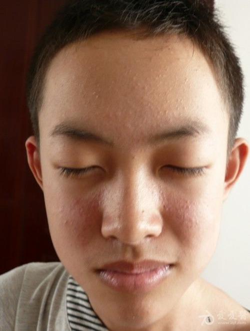 孩子脸上的皮疹