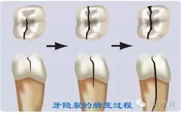 牙隐裂是个什么东东?