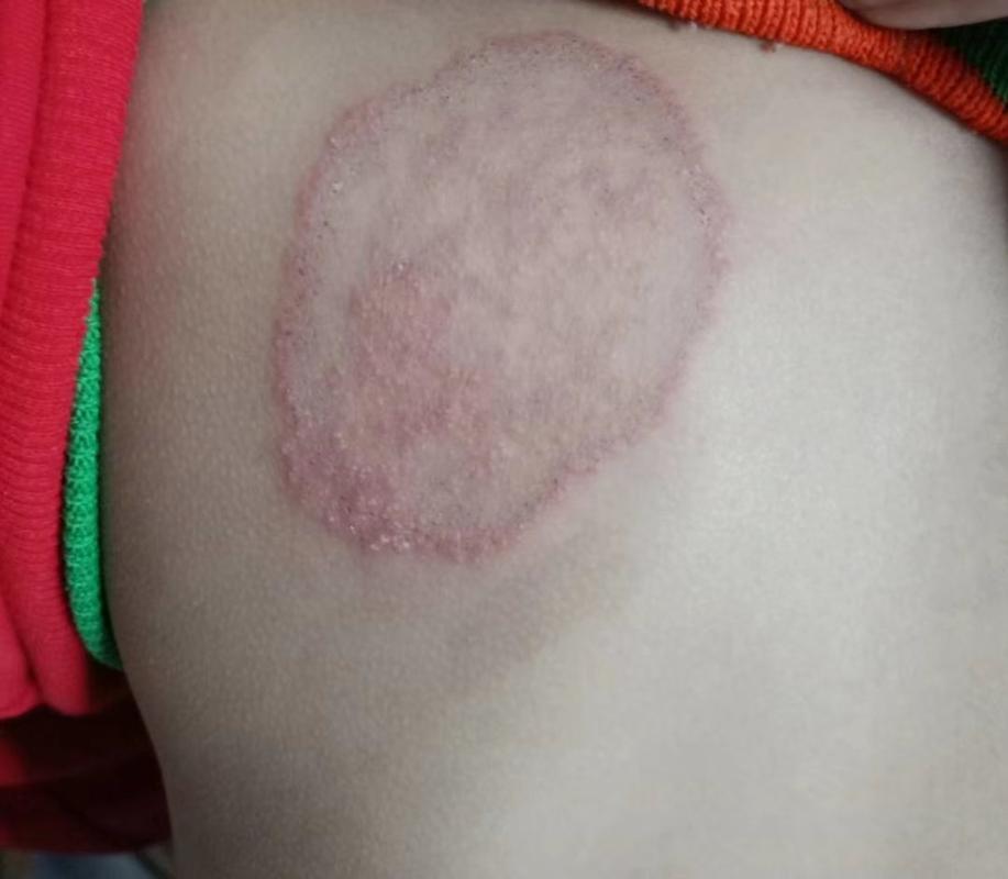 体癣是一种真菌感染皮肤病,不能用治疗皮炎湿疹类的激素类的药,不然很