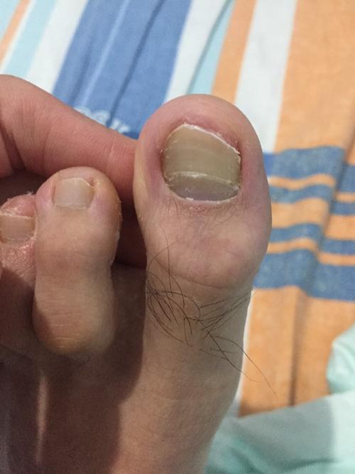 是灰指甲还是缺钙?急