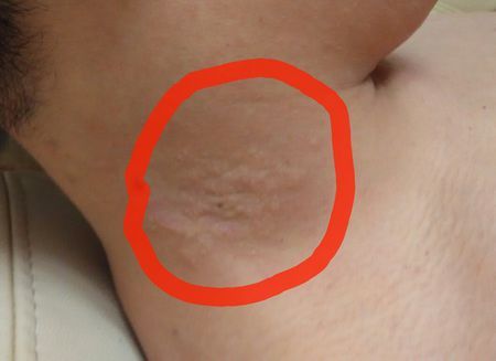 脖子上长了两块癣一样的东西,求鉴定是什么东西,用啥药?