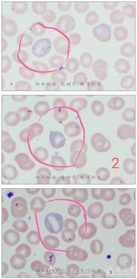 红细胞的异常形态