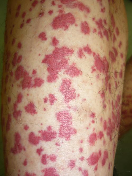 双下肢皮肤出现紫癜,喝酒后紫癜变成鲜红色,无自觉症状.