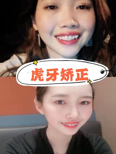 凸面型龅牙,虎牙矫正真实报告