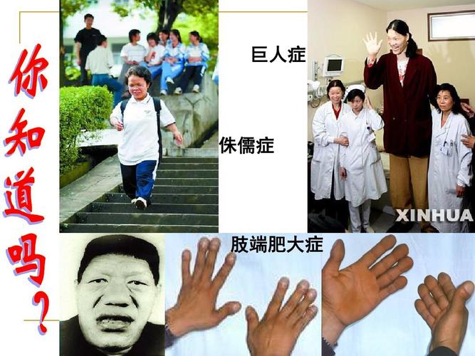 巨人症 侏儒症 肢端肥大症