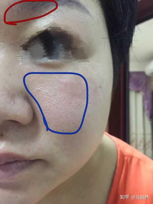 眉毛部位的皮肤潮红是脂溢性皮炎的典型特点