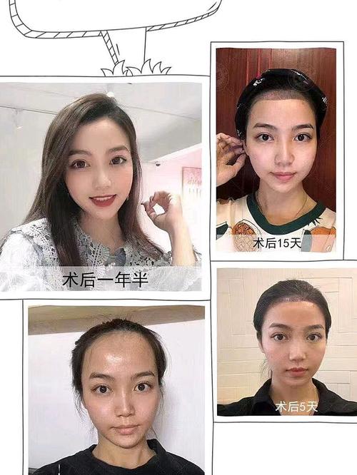 美女发际线术后一年半案例分享