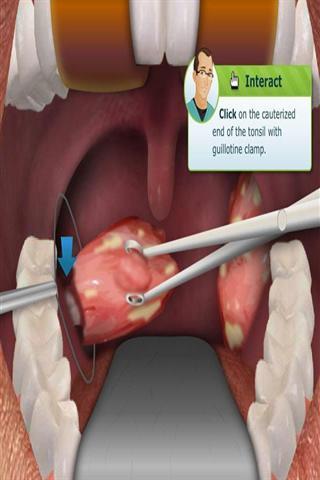 扁桃体切除手术