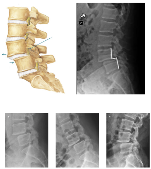 腰椎滑脱是什么回事?应该怎么诊断与治疗?