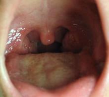 如果是,那么不必担心,那是扁桃体,是正常的器官.