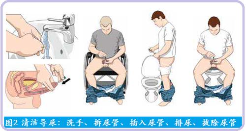 图2清洁导尿示意图.png
