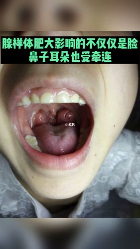 腺样体肥大影响的不仅仅是脸,还有并发症_腺样体肥大