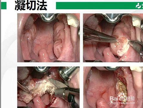 因炎症的反复刺激而发生的病理性增生,称腺样体肥大,本病最多见于儿童
