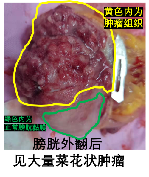 腹腔镜膀胱癌根治术(女性)