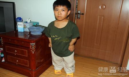 正文  在我们生活中总是看到那些个子非常矮小的人,其实他们是患上