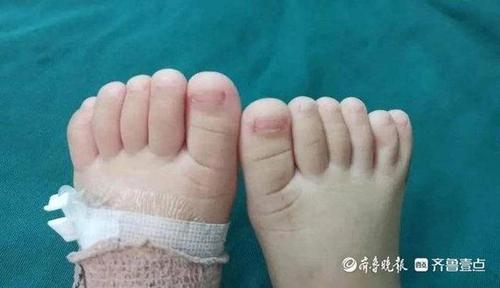 六指宝宝急坏家人日照市人民医院妙手复原