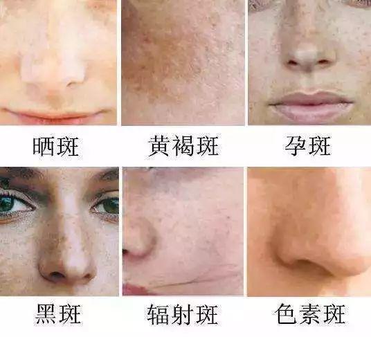 身体毒素不能及时排出体外,就会加重我们皮肤粗糙,色斑,面色暗黄,皱纹