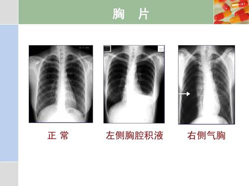胸 片 正常 左侧胸腔积液 右侧气胸