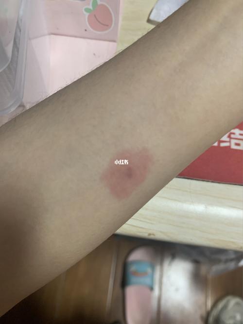 今天早上大概10点左右做的肺结核皮试,晚上这个样子正常吗_肺结核皮试