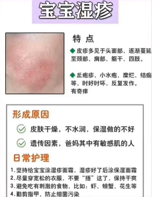 (营养分享)湿疹类型以及处理办法