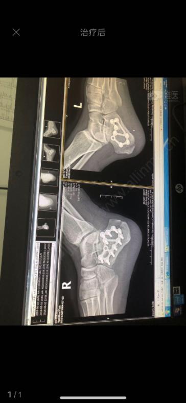 跟骨骨折切开复位钢板内固定术