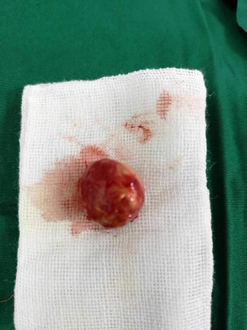 皮脂腺囊肿病例分享